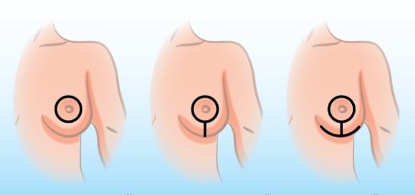 операционные доступы при подтяжке груди