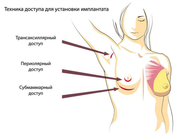 Виды имплантов для увеличения груди