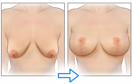 эндопротезирование груди совместно с мастопексией