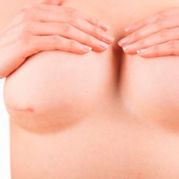 грудь как выглядит после увеличения