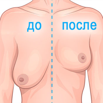 подтяжка грудных желез - до и после