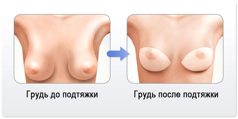 грудь до и после мастопексии