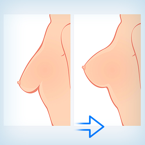 мастопексия совместно с эндопротезированием, увеличением груди
