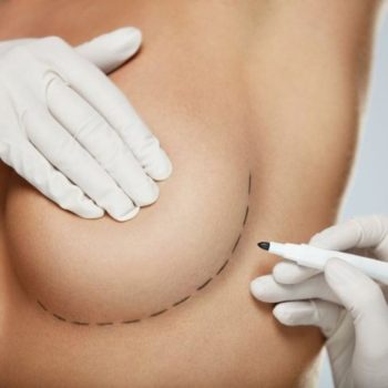 Маммопластика груди без имплантов