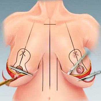 процесс подтяжки груди