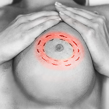 периареолярная подтяжка груди