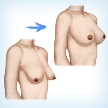 подтяжка плюс увеличение груди