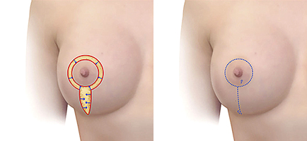 прямой разрез для подтяжки груди