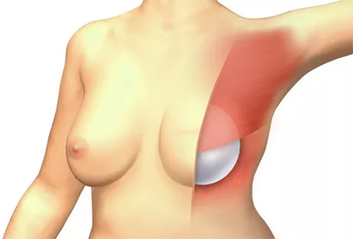 протезирование грудных желез после мастэктомии