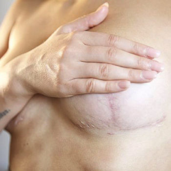 рубцы, шрамы после операции по подтяжке груди