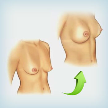 совместная операция - увеличение груди и мастопексия