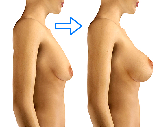 увеличение груди плюс подтяжка