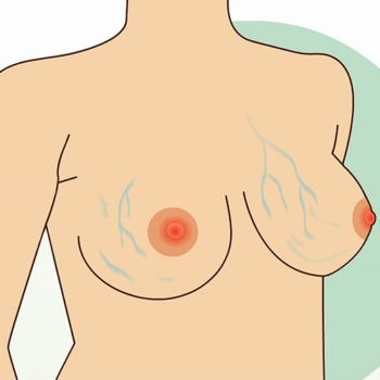 вены на груди после маммопластики
